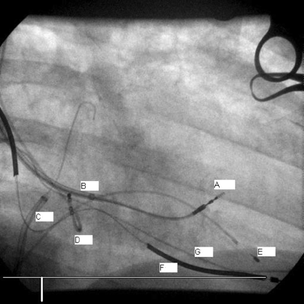 LV lead placement (RAO view). A, Endo-cardial LV lead in position; B, deflectable tip select secure sheath; C, Daig SL1 transeptal sheath in RA with 0.35 inch J tip guidewire in LA; D, temporary CS electrode; E, temporary RVA electrode; F, Active fixation DF and pacing RVA lead; G, old RVA lead (see Figure 1 for abbreviations).