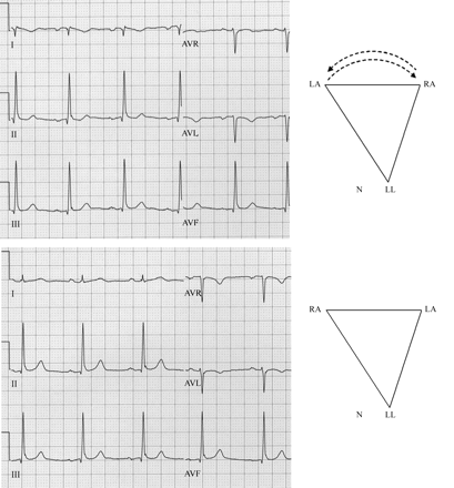 Peripheral leads of a 12-lead electrocardiogram recorded in a healthy young participant in a drug trial with right arm–left arm cable reversal (top panel) and with correct cable connections (bottom panel). In this one and in the subsequent figures, the positions of the peripheral electrodes and their effect on Einthoven’s triangle are schematically presented (in this figure to the right of each ECG). The cable reversal can be recognized by the negative P–QRS in lead I and positive P wave in lead AVR. Note, however, that the frontal QRS axis is very similar in the ECG and without cable reversal (96 and 86°, respectively). See the text for details.