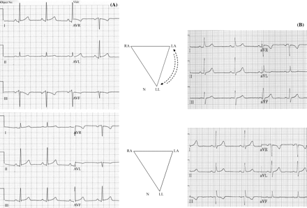 Changes in the morphology of the P wave can help to detect left arm–left leg cable reversal. The figure shows peripheral leads of 12-lead ECGs recorded in a 25-year old healthy participant in a drug trial (A) and in a 34-year-old man with mild arterial hypertension (B). The ECGs with left arm–left leg cable reversal are presented in the top panels, whereas those with correct cable connections are shown in the bottom panels. The positions of the peripheral electrodes with incorrect (top) and correct cable connections (bottom) are schematically presented in the middle panels.