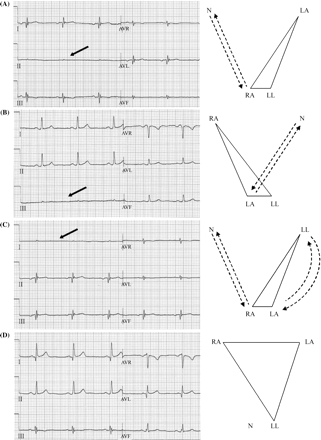 Peripheral leads of a 12-lead ECG recorded in a 34-year-old healthy man with intentional interchange of the right arm–right leg (A), left arm–right leg (B), both arms–corresponding leg electrode cables (C) and with correct cable connections (D). To the right of each ECG are schematically presented the positions of the peripheral electrodes. Note that unlike the cable interchanges presented in Figures 13, interchange of the right leg (ground) electrodes distorts Einthoven’s triangle and Wilson’s central terminal. Also note that the telltale sign of interchange of a peripheral and the ground electrode is the appearance of almost a flat line in one of the standard limb leads (see the arrows). See the text for further details.