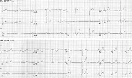 Two resting 12-lead ECGs recorded ∼15 min apart in a 40-year-old man with mild arterial hypertension with correct cable connections (bottom panel) and with intentional interchange of the right leg (ground) cable end the V2 electrode cable (top panel). Note that with this cable interchange, all leads are unchanged except lead V2, look similar to lead AVF but with reduced amplitude. This is practically lead VF (i.e. lead AVF without augmentation). See the text for details.
