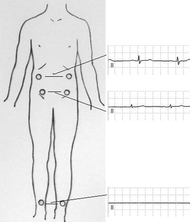 Schematic presentation of the leg electrodes positioned at the level of the ankles, cristae iliacae and the subcostal regions. To the right of the human figure are presented lead II of 3 standard 12 lead ECGs consecutively recorded in one subject with the leg electrodes attached to places marked on the human figure. The rest of the electrodes have been attached to the standard places in all ECGs. In each ECG, the right arm and right leg electrodes have been deliberately interchanged.