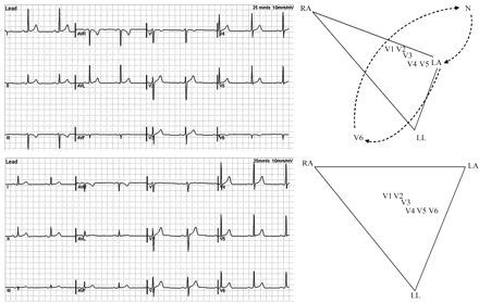 Standard 12-lead electrocardiograms recorded in a healthy young male subject during a drug trial. Top panel: The left arm cable has been connected to the V6 electrode, the V6 cable has been attached to the right leg, and the ground electrode has been connected to the left arm. The participants in the trial have been left to walk freely between recording sessions with the electrodes and cable connected to them and most probably, this subject has decided to re-connect himself inadvertently disconnected cables. Bottom panel: Electrocardiogram in the same subject with correct cable connections.