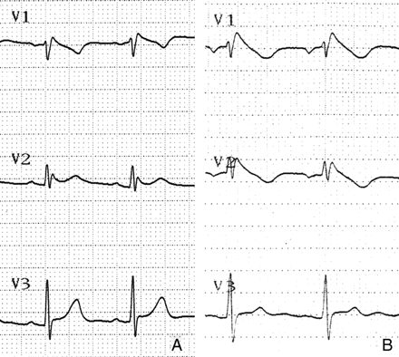 Positive sodium-channel-blocking test with procainamide. The baseline type 2 ECG pattern with saddleback ST-segment configuration (A) was converted to the diagnostic type 1 pattern with coved ST-segment elevation (B).