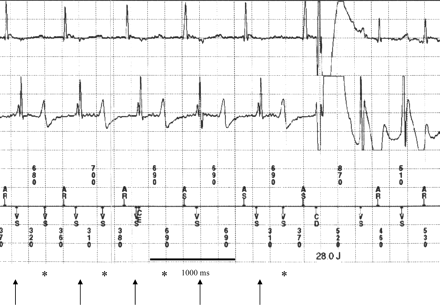 Ventricular oversensing due to T-wave oversensing, resulting in inappropriate shock therapy. Correctly sensed R-waves are marked with downward arrow, T-wave oversensing (misinterpreted as ventricular exitation) is marked with asterisk.