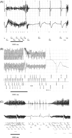 (A) Myopotential oversensing caused by trunk and upper arm musculature while rising up after echocardiography. Myopotential oversensing was reproducible during the following provokation manoeuvre. (B) Oversensing due to external electromagnetic field. Inadequate shock delivery caused by electromagnetic field (electromagnetic field transmitter)—noise signals induced in atrial and ventricular channel misinterpreted as ventricular fibrillation, detailed description see text. (C) Inappropriate shock delivery caused by oversensing due to alternating current stimulation therapy in a patient with myopathia.