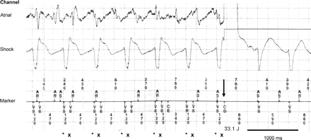 Double-counting while incessant (haemodynamically tolerated) slow VT (CL 590 ms), every QRS complex is counted twice as marked with asterisk and x. The delivery of an inappropriate shock delivery is marked with downward arrow.