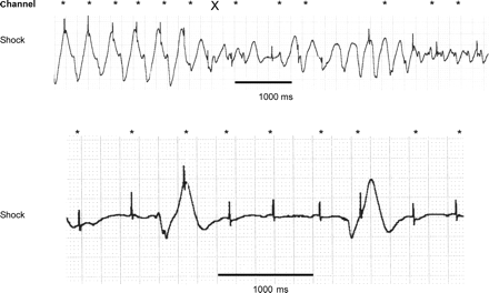 (A) Intermittent pacemaker undersensing while running slow VT (pacemaker spikes marked with asterisk), acceleration to VF due to pacemaker (marked with X). (B) Exit block of pacemaker after shock delivery, pacemaker (DDD 55–130) spikes are misinterpreted as QRS complexes by implanted cardiac defibrillators, resulting in haemodynamically not tolerated bradycardia (slow ventricular rhythm).