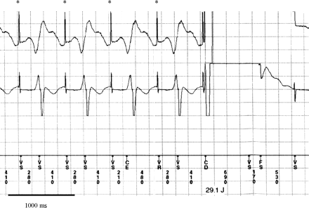 Interaction of dual chamber pacemaker and implanted cardiac defibrillators (ICD) DOO 85-Modus of implanted pacemaker (Medtronic TheraDR) while magnet test, atrial unipolar spikes are marked with asterisk, bipolar ventricular spikes are not sensed by ICD, inappropriate shock delivery triggered by misinterpreting atrial spikes.