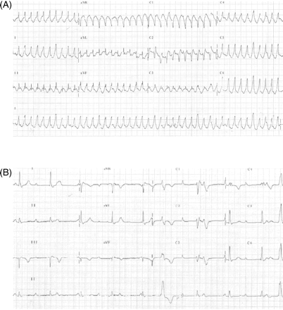 12-lead ECG (A) on admission and (B) after DC cardioversion. (B) Complete heart block is seen with an escape rhythm conducted with a typical right bundle-branch block morphology.