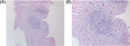 Histology (haematoxylin and eosin stain) showing non-caseating granuloma with multinucleate giant cells at (A) low (×100) and (B) high (×200) magnification.
