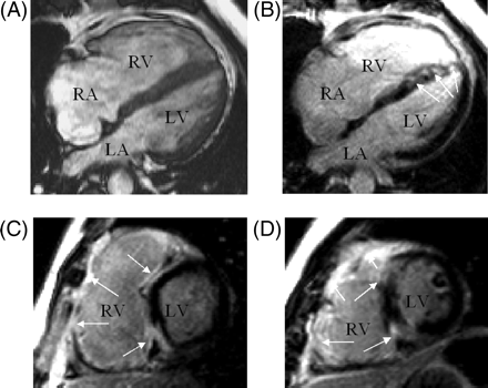 Cardiac magnetic resonance imaging (A) four-chamber end-diastolic gradient echo. (B–D) Inversion recovery gradient echo delayed contrast images. Normal myocardium black. Abnormal contrast enhancement arrowed. The septum is diffusely enhanced and shows marked anteroseptal enhancement, which is likely to cause complete heart block ±RBBB. (B): Four-chamber; (C): basal short axis; (D): mid ventricular short axis. RA, right atrium; LA, left atrium.