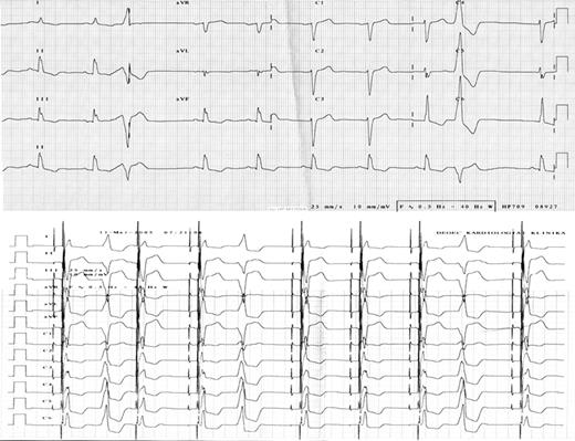 12-Lead ECG before (upper panel) and after (lower panel) CRT implantation. Frequent ventricular ectopies can be observed in both recordings.