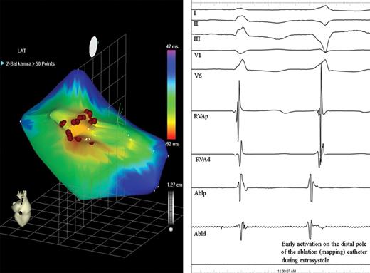 Electroanatomical activation map of the left ventricle from a posterior view, obtained during monomorphic ventricular premature beats (left). The site of the earliest activation in the left ventricle (red area) was covered by several RF applications (red dots) to ensure a long-term result. We recorded more than one point on the CARTO map at each application. Right: Intracardiac recordings show early local activation on the distal ablation pole (Abld) at the site of successful RF application preceding the QRS onset by 44 ms (I-II-III-V1-V6: surface ECG leads; RVAp, RVAd: proximal and distal poles of the catheter in the right ventricular apex; Ablp: proximal ablation electrodes).