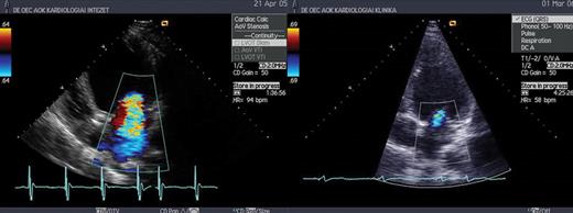 Severe mitral regurgitation 6 months after CRT implantation (left), and minimal mitral regurgitation 6 months after ablation (right).