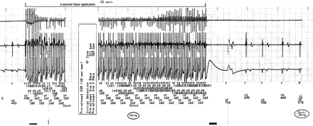 ICD memory record of NMI discharge. This interrogated electrogram strip from the ICD memory after the NMI application shows onset of rapid rate detection with initiation of the application. The device responds by starting to charge its capacitors. However, prior to shock delivery, the application is terminated and the device aborts the shock delivery. Note that detected cycle length corresponds best to the detected NMI pulses rather than the ventricular electrograms even though accelerated ventricular capture can be appreciated visually at cycle lengths around 240 ms.