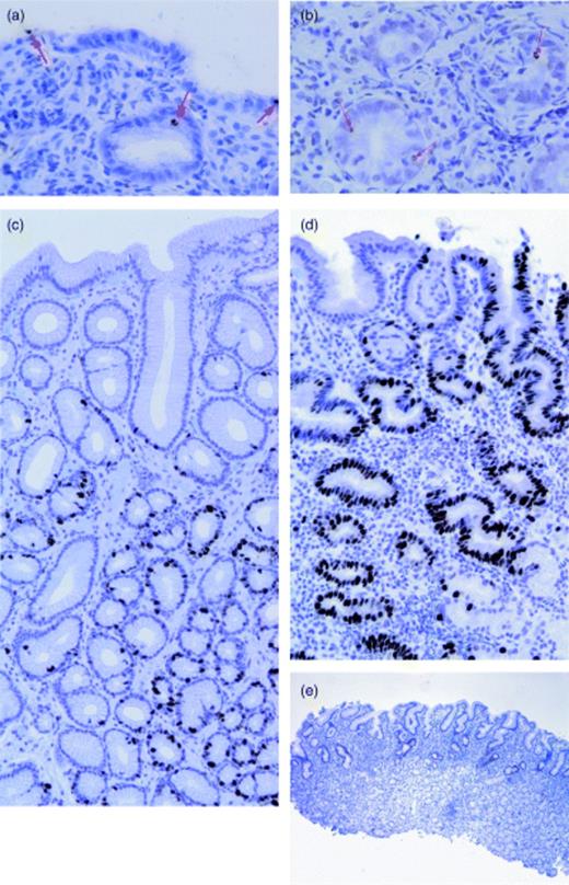 Apoptotic activity, visualized by the TUNEL method in a H. pylori-positive specimen in the superficial compartment (a) and in the deep compartment (b). Apoptotic bodies were scarce in H. pylori-negative specimens (not shown). Immunohistochemical expression of nuclear Ki-67, confined to the deep compartment in a H. pylori-negative biopsy, visualizing the normal regenerative zone, as opposed to the nonreaction of the more superficial cells (c), expanding of the Ki-67-positive lining cells to the superficial compartments in a H. pylori-positive specimen (d). Note the tortuous course of the foveolae lined by extensively labelled epithelial cells, as opposed to the straight course of the more sparsely decorated specimens. Immunostaining of p53 is readily apparent in H. pylori-positive specimens (e), as opposed to its virtual inapparence in H. pylori-negative biopsies (not shown).