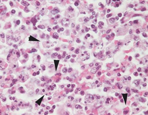 Splenic histopathology from a patient who died after HGA. Note the hemo- and leukophagocytic cells denoted by the arrows. Hematoxylin and eosin stain; original magnification ×400.