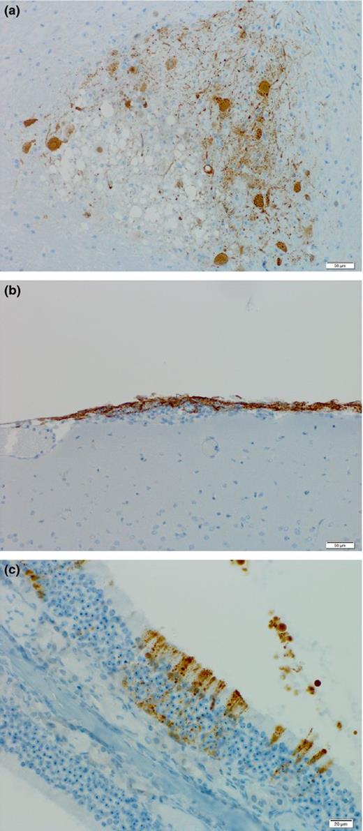 Tropism of lethal Henipavirus infection in hamsters. Hendra virus antigen is present in (a) focal areas of neuropil vacuolization in the brain, (b) areas of meningitis, and (c) olfactory epithelium in nasal turbinates. Sections were stained for HNV nucleoprotein (brown).