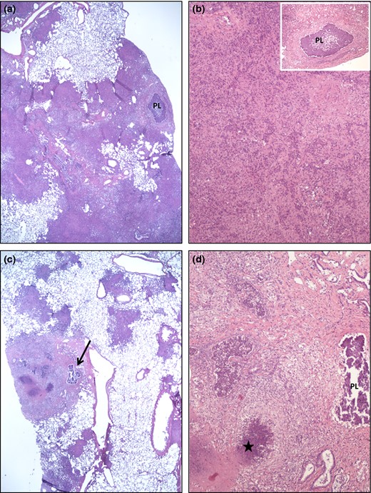 Lung micrographs from WT (H37Rv) infected guinea pigs. The pathological changes are dominated by secondary lesions with dense, coalescing (a) and (c) multifocal infiltrates of lymphocytes and macrophages. Occasional primary granulomas with central mineralization (PL in a, b insert, d; arrow in c) are seen within the extensive secondary changes. Areas of necrosis (star in d) and variable fibrosis characterize the secondary lesions (minimal fibrosis in a and b; moderate fibrosis in d).