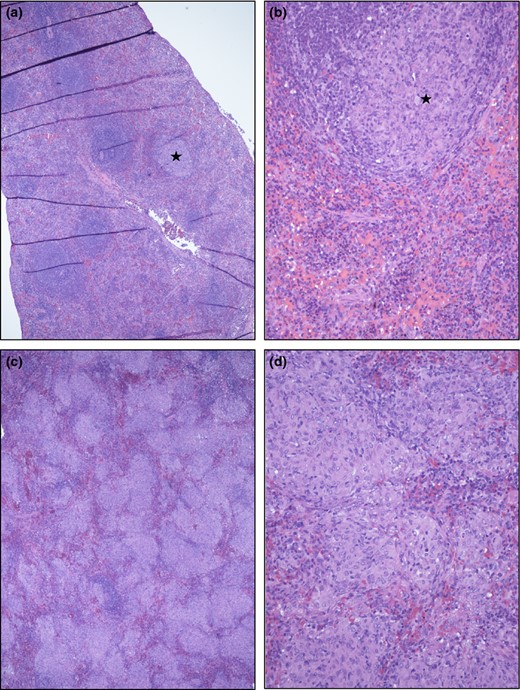 Spleen micrographs from ΔHspX (a and b) and WT (c and d) Mtb infected guinea pigs. (a and b) No or only occasional small granulomatous foci (star in a and b) were seen, involving < 10% of the parenchyma. (c and d). In contrast, more than 30% and often more than 60% of the spleen parenchyma was involved, as illustrated in c and d. The multifocal to coalescing cellular infiltrates are composed mainly of epitheloid macrophages with variable admixtures of lymphocytes and occasional multinucleated giant cells.