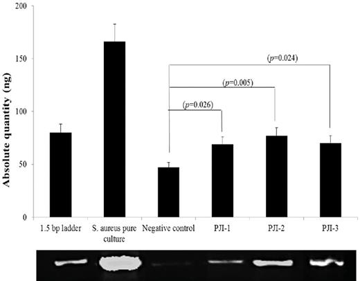 Gel electrophoresis of amplification of PCR products. (i) 1.5 bp ladder, (ii) pure culture of S. aureus, (iii) negative control 1, (iv) suture material 1 (PJI-1), (v) suture material 2 (PJI-2) and (vi) suture material (PJI-3), ng—nanogram.
