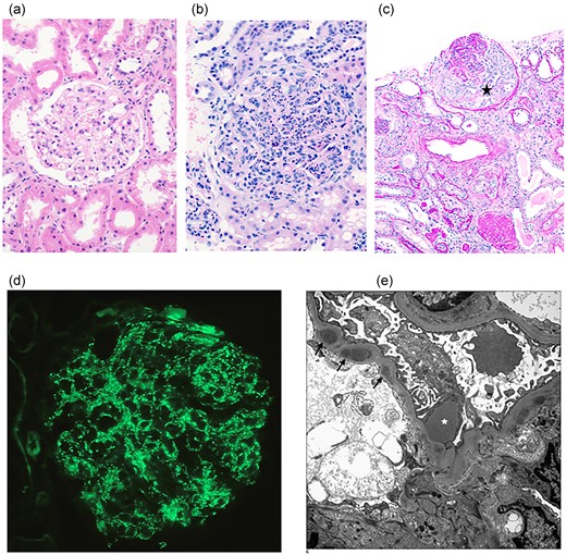 Histological features of kidney pathology. (a) Light microscopy demonstrating normal renal cortex (Haematoxylin and Eosin stain, 200 × magnification); (b) Light microscopy demonstrating abnormal glomerulus in PSGN with diffuse hypercellularity including numerous neutrophils and mesangial cell increase (Haematoxylin and Eosin stain, 200 × magnification); (c) In PSGN, a cellular crescent (black star) is observed in the glomerulus (Periodic acid-Schiff/diastase stain, 100 × magnification); (d) Immunofluorescence demonstrating granular staining of C3 along the glomerular capillary loops in PSGN (400 × magnification); (e) Electron microscopy demonstrating characteristic subepithelial deposit/hump (white star) and several smaller subendothelial deposits (arrows) in PSGN.