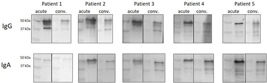 Immunoreactivity profiles of acute and convalescent COVID-19 patients. Sera was obtained from each patient during admission to the hospital and three weeks after the last symptoms of infection have ceased. All blots were performed in the same conditions.