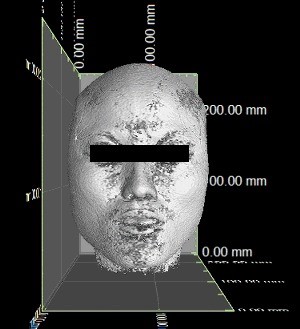 The stereogram of the three-dimensional reconstruction of MRI data.