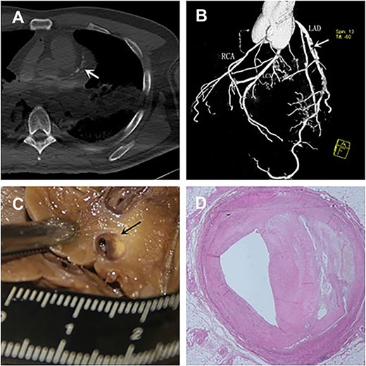 Comparison of angiographic and histopathological images. (A) Multi-slice computer tomography (MSCT) scan indicated calcification of the left main trunk and the left anterior descending branch (white arrow). 3D angiographic images (B) specimens (C) and histopathological images (D) showed the anterior descending branch severe stenosis.