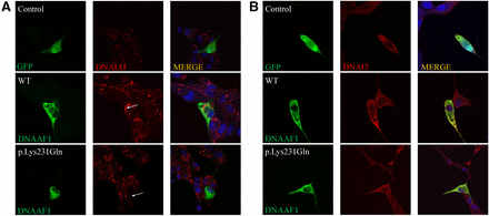 Axonemal defects of the IDA (DNALI1) in MDCK cells transfected with DNAAF1 missense mutant. High-resolution immunofluorescence microscopy of MDCK cells was performed with antibodies directed against the IDA component DNALI1 (A) and ODA chains DNAI2 (B). In control and GFP-tagged DNAAF1 wild-type (WT) transfected cells, DNALI1 and DNAI2 localize within the cytoplasm, whereas DNALI1 labeling is absent from the DNAAF1 p.Lys231Gln mutant transfected MDCK cells. The staining pattern of DNAI2 (B) is not obviously changed for the mutant. Nuclei were stained with DAPI (blue). GFP and GFP-tagged DNAAF1 protein are shown in green. DNALI1 and DNAI2 are shown in red.
