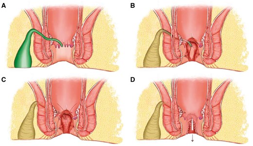 Surgical diagram of fistula occlusion with the internal sphincter flap. (A) A suprasphincteric anal fistula is identified with IO located at 6 o'clock. (B) A segmented processing technique consists of the fistulectomy in the ischiorectal fossa and ends at the lateral of the external sphincter, resection of IO and the internal sphincter underneath, and curettage of the fistula in the intersphincteric space and external sphincter. (C) Ligation or suture is conducted to close the tract that went through the external sphincter, and an internal sphincter flap is prepared for the coverage. (D) Flap occlusion is accomplished with continuous barbed suture, followed by the closure of the intersphincteric space. IO = internal opening.