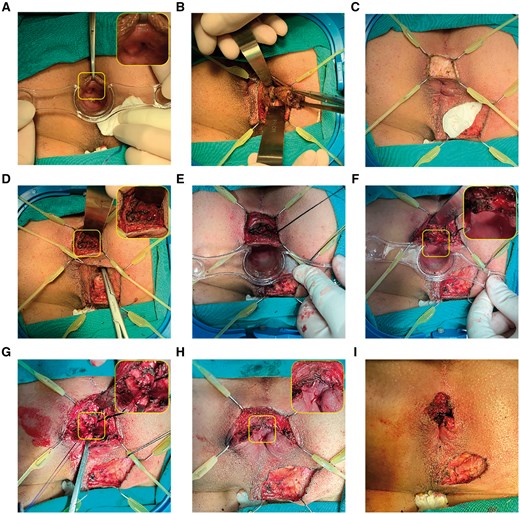 A posterior high transphincteric anal fistula was treated with fistula occlusion with the internal sphincter flap. (A) The IO located at 6 o'clock was identified by administering low-dose methylene blue with hydrogen peroxide. (B) A tunnel-like core fistulectomy was conducted from the superficial external opening into the deep ischiorectal fossa. (C) Intersphincteric incision was applied with a retractor at the corresponding anal clock of IO. (D) The portion of the tract that crossed the external sphincter was found, and the tip of the forceps is shown in the image. (E) Deep intersphincteric plane was fully laid open, followed by curettage. (F) The IO, together with the internal sphincter, was resected and incised separately. (G) Two intermittent stitches were applied in the intersphincteric space to sew the defect caused by the tract crossing the external sphincter. (H) The internal sphincter flap was further sealed or advanced up to the external sphincter to cover the stitches at the defect by using absorbable continuous barbed suture. (I) Completed surgery. IO = internal opening.