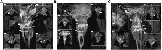 Different types of posterior complex anal fistulas from our cohort, as seen on coronal contrast-enhanced fat-suppressed T1-weighted images with different corresponding sections. (A) The suprasphincteric anal fistula with multiple branches in the deep intersphincteric horseshoe tracts and right ischiorectal fossa. (B) The low transphincteric anal fistula with right ischiorectal fossa abscess and deep intersphincteric horseshoe tracts, extending along the left combined longitudinal muscle into the supralevator area of the rectal muscle. (C) The high transsphincteric anal fistula in the left puborectal muscle with up spread supralevator into the pelvirectal space. The arrows are pointing at the IO. The triangles represent deep branches. IO = internal opening.