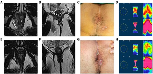A high transsphincteric anal fistula with abscess in the right ischiorectal fossa and bilateral intra-levator ani muscle were treated by fistula occlusion with the internal sphincter flap with complete healing on follow-up. Preoperative and postoperative magnetic resonance imaging scans were performed to verify the complexity of the tract and internal opening and recovery by (A, E) axial T2-weighted images and (B, F) coronal T2-weighted images. (C, G) Photograph of the anus shown preoperatively and at the last follow-up. (D, H) The anorectal manometry assessments were carried out preoperatively and at the last follow-up. The arrows are pointing at the tracts. The triangle represents the IO. IO = internal opening.