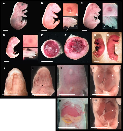 Overt phenotype of late-term PatDp(dist7)T9H-0/Tg fetuses. (A) Fetus, 18½ dpc, wild type. (B) Fetus, 18½ dpc, PatDp(dist7)T9H-0/Tg, Igf2+.+; insets show eye and forepaw, with arrow indicating additional digit or polydactyly. (C) Fetus, 18½ dpc, PatDp(dist7)T9H-0/Tg, Igf2+/−, insets and arrow as for B. (D) Fetus, 18½ dpc, PatDp(dist7)T9H-0/Tg, Igf2−/−, insets as for B. (E) Placenta, 16½ dpc, wild type. (F) Placenta, 16½ dpc, PatDp(dist7)T9H-0/Tg, Igf2+/+, uterus mate to E. (G) Neonate, ½ days post partum (dpp), Igf2+/−. (H) Neonate, ½ dpp, PatDp(dist7)T9H-0/Tg, Igf2+/−. (I) Exposed palate, 18½ dpc, PatDp(dist7)T9H-0/Tg, Igf2+/+. (J) Exposed palate, 17½ dpc, Cdkn1c−/+. Arrow indicates cleft in palate. (K) Abdomen, 18½ dpc, wild type. (L) Abdomen, 18½ dpc, PatDp(dist7)T9H-0/Tg, Igf2+/+. Arrow indicates hernia adjacent to the umbilicus. (M) Exposed abdomen of K. (N) Exposed abdomen of L. Bars, 0.5 cm.