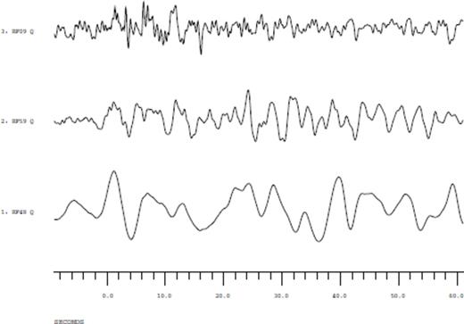 Data example for the 2003 August 4 event. The traces show final receiver functions computed from records of broad-band station RF48 (bottom) and of two short period stations, one of which located in the back arc (RF59, middle) and the other one placed in the fore arc region (RF09, top). A 5 Hz lowpass filter is applied to avoid aliasing effects caused by resampling. Comparison of the waveforms demonstrates the different frequency contents. As the PC profile is much shorter, we only show stations from the RF profile.