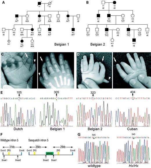 Figure 5. (A, B) Pedigree structure of part of a Belgian family 1 (A) and family 2 (B) with autosomal dominant preaxial polydactyly. Solid symbols represent affected individuals; open symbols represent unaffected individuals. Co-segregation of the A/T mutation in Belgian 1 and the T/C mutation in Belgian 2 with the PPD phenotype is indicated. (C) Normal and X-ray images of the right hand of affected individual IV-2. Note the extra biphalangeal thumb (arrowhead), with metacarpal, connected to a tri-phalangeal thumb (arrow). (D) Normal image of both hands of the affected individual IV-2 of Belgian family 2. Note the triphalangeal thumb on the left hand (arrow). (E) Sequence electropherogram of mutations found in the ZRS. Positions of the heterozygous mutations in the human sequence of the ZRS (Fig. 2B) are indicated above. (F) Schematic representation of Lmbr1 intron5 in wild-type mice and in Ssq. Exons 5 and 6 are depicted by dark and light blue boxes, respectively. The ZRS is shown as a yellow box and the breakpoints of the duplication marked by arrows. In Ssq, the inserted multiple transgene elements are shown as the green box. (G) Sequence electropherogram of a wild-type and an Hx/Hx mouse. The G to A mutation is at position 545 of the mouse sequence of ZRS as indicated in Figure 2B.