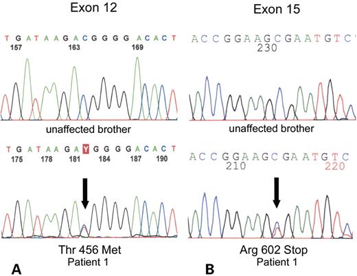 Figure 1. Partial sequences of exon 12 (A) and exon 15 (B) of ATP8B1 gene of patient 1 and his unaffected brother. Note heterozigosity (both T/C; arrows) in exons 12 and 15 of patient 1, leading to Thr456Met and Arg602Stop changes, respectively. Both mutations were also present in the two affected siblings (patients 2 and 3).