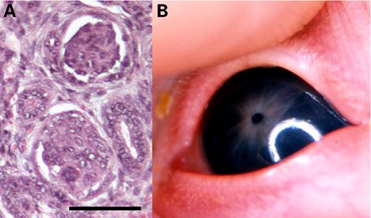 Figure 1. Main clinical features of Pierson syndrome: (A) diffuse mesangial sclerosis in a kidney biopsy (bar: 100 µm) and (B) clinical appearance of the ocular anomalies in an affected newborn.