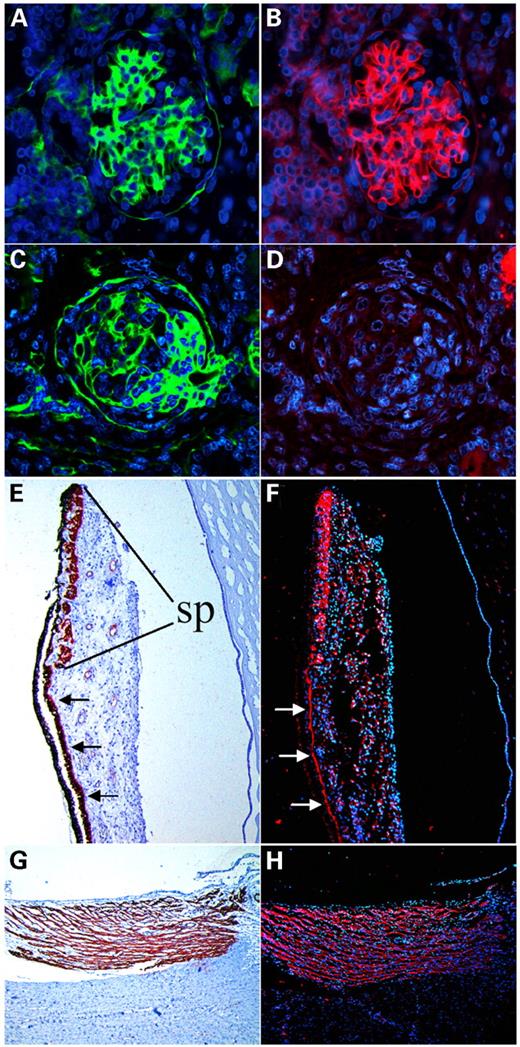 Figure 5. Immunohistology: Fixed, paraffin-embedded tissue sections analyzed by simultaneous indirect immunofluorescence using antibodies against collagen IV as a control protein for glomerular BL (green; A and C) and against laminin β2 (red; B, D, F, H). Nuclear stain with DAPI (blue) is displayed as background. (A and B) Normal neonatal kidney; (C and D) kidney tissue from a newborn patient with the mutation R1562X showing a structurally alterated glomerulus with positive staining for collagen IV (C) but lack of laminin β2 immunoreactivity (D). (E–H) Corresponding eye sections of a newborn control analyzed by immunoperoxidase using antibodies against smooth muscle actin (E and G) and by immunofluorescence using laminin β2 antibodies (F and H). Specific expression of laminin β2 surrounding muscle cells of sphincter pupillae (sp) (F) and ciliary muscle (H); bandlike laminin β2 expression at the basal site of the anterior layer of the posterior iris epithelium that forms the dilatator pupillae (arrows).