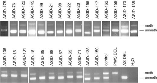 Figure 1. MS-PCR analysis of 26 AS patients who have an ID but no IC deletion. A faint methylated band is present in all ASID patients. The patients with a paternal (PWS DEL) or a maternal (AS DEL) deletion of 15q11–q13 show a typical PWS and AS methylation pattern, respectively. The normal control has two bands of equal intensity; meth, methylated and unmeth, unmethylated.