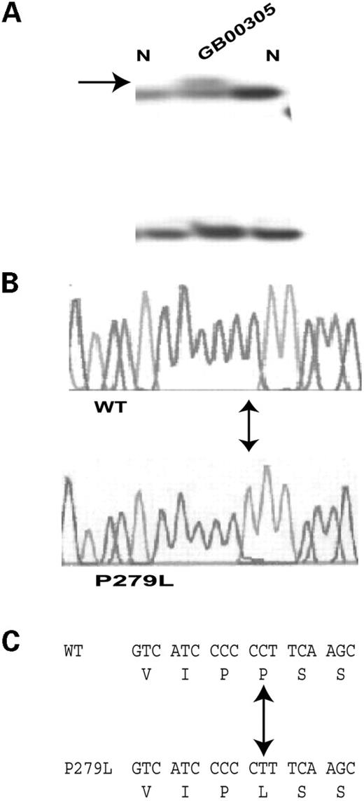 Figure 2. Identification of MEF2A mutation P279L in CAD patient GB00305. Figure caption is as described in the legend to Figure 1.