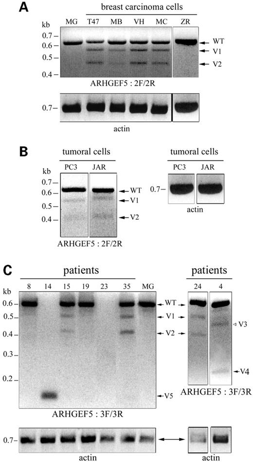 Figure 3. Identification of novel ARHGEF5/TIM alternative transcripts amplified from tumoral breast cells and tissues. RT–PCRs were performed with the primer pair 2F/2R (A, B) and followed by a nested PCR with primers 3F/3R (C). The amplified products were resolved on a 2% agarose gel stained with ethidium bromide and negative images of the photographs are shown. (A) normal mammary gland (MG) and breast carcinoma cell lines T47D (T47), MDA-MB231 (MB), VHB-1 (VH), MCF7 (MC), ZR-75 (ZR): three fragments corresponding to wild-type (WT), V1 and V2 variant ARHGEF5 transcripts were detected in 4/5 breast tumor cells. (B) tumoral cells from various origins: 2/11 cell lines, PC3 (prostate carcinoma) and JAR (choriocarcinoma), expressed the V1 and V2 variants at a low level. (C) Breast carcinoma samples: in 15/33 patients, V1, V2 and three additional variants (V3–V5) were observed associated or not with the WT transcript. Patient 23 did not express ARHGEF5/TIM. RT-PCRs with primers derived from β-actin, performed as controls, are shown.