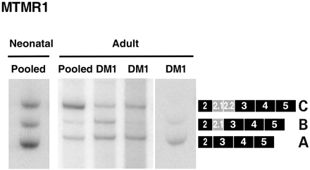 Figure 7. MTMR1 alternative splicing is disrupted in DM1 heart tissue. cDNA was synthesized from pooled commercial RNA or from unrelated individuals with DM. The adult pool consisted of heart tissue from 20–78-year-old individuals and the fetal pool was from heart tissue of 18- to 21-week-old fetuses. Autopsy samples of DM heart tissue were collected from 26-, 50- and 52-year-old patients. RT–PCR analysis using primers the flanking exons 2 and 5 indicates that adult DM tissues show increased retention of the fetal MTMR1 isoforms A and B.