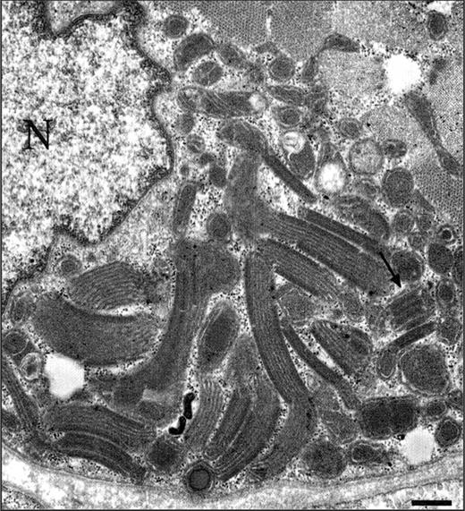 Figure 3. Electron microscopy demonstrating increased amount of structurally abnormal mitochondria with para-crystalline inclusions (arrow) in a muscle fiber (N, nucleus), bar, 1.1 µm.