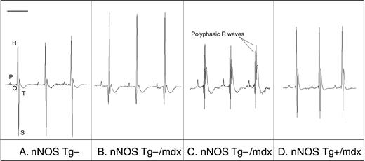图6。mdx小鼠的心电图描记显示，随着nNOS转基因的心脏表达，DMD样异常得到改善。使用植入式遥测设备收集的典型心电图描记。（A） nNOS Tg−鼠标的正常跟踪。（B） nNOS Tg−/mdx追踪显示深Q波、峰值R波和减弱S波。（C） nNOS Tg−/mdx追踪显示多相R波。（D） nNOS Tg+/mdx小鼠追踪显示标准化Q波、R波和S波。条形=100 毫秒。