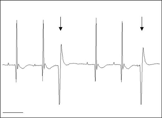 图8。Mdx小鼠经常出现PVC。nNOS Tg−/mdx小鼠的代表性ECG描记显示在DMD患者中也常见的PVC（箭头）。条形=100 毫秒。