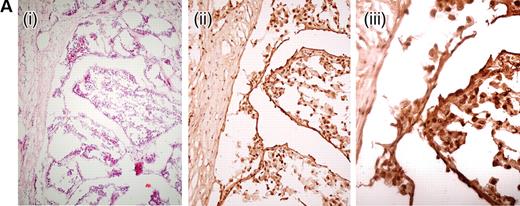 Figure 1. Representative HIF1α expression in HLRCC tumours by immunohistochemistry.(A) A frozen section of a HLRCC papillary type II renal tumour showing haemotoxylin and eosin (H&E) ×10 (i), HIF1α×10 (ii) and HIF1α×20 (iii). Even allowing for some background staining due to biotin levels in the kidney, there is strong nuclear expression of HIF1α.(B) A lymph node metastasis from a HLRCC collecting duct renal cancer showing H&E×10 (i), HIF1α×10 (ii), H&E×20 (iii) and HIF1α×20 (iv). There is strong HIF1α staining in the nuclei of tumour cells and negative staining in the stromal tissue, well-illustrated by the horizontal bands of stromal cells without HIF1α staining in (iv).