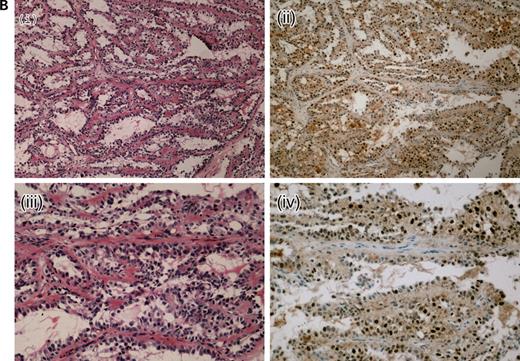 Figure 1. Representative HIF1α expression in HLRCC tumours by immunohistochemistry.(A) A frozen section of a HLRCC papillary type II renal tumour showing haemotoxylin and eosin (H&E) ×10 (i), HIF1α×10 (ii) and HIF1α×20 (iii). Even allowing for some background staining due to biotin levels in the kidney, there is strong nuclear expression of HIF1α.(B) A lymph node metastasis from a HLRCC collecting duct renal cancer showing H&E×10 (i), HIF1α×10 (ii), H&E×20 (iii) and HIF1α×20 (iv). There is strong HIF1α staining in the nuclei of tumour cells and negative staining in the stromal tissue, well-illustrated by the horizontal bands of stromal cells without HIF1α staining in (iv).
